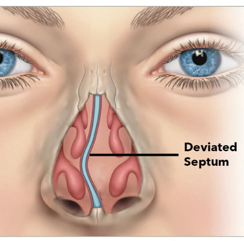 Sleeping Soundly with a Deviated Septum